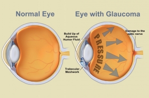 glaucoma1